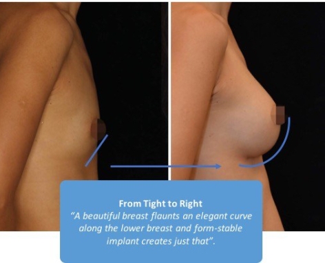 breast-curve1.jpg