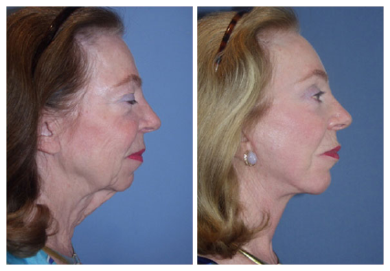 Chin implant for turkey double chin