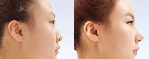 nose implant